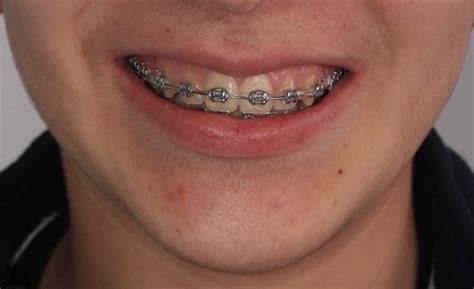 diferente de brackets metalicos y esteticos|brackets invisibles precio.